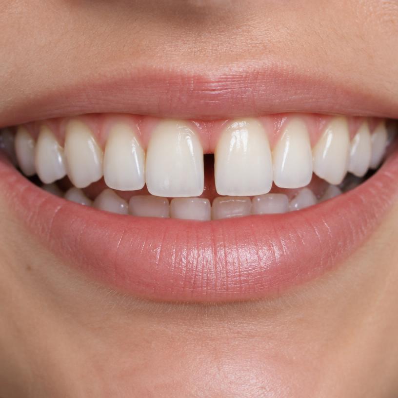 Exemplo de diastema